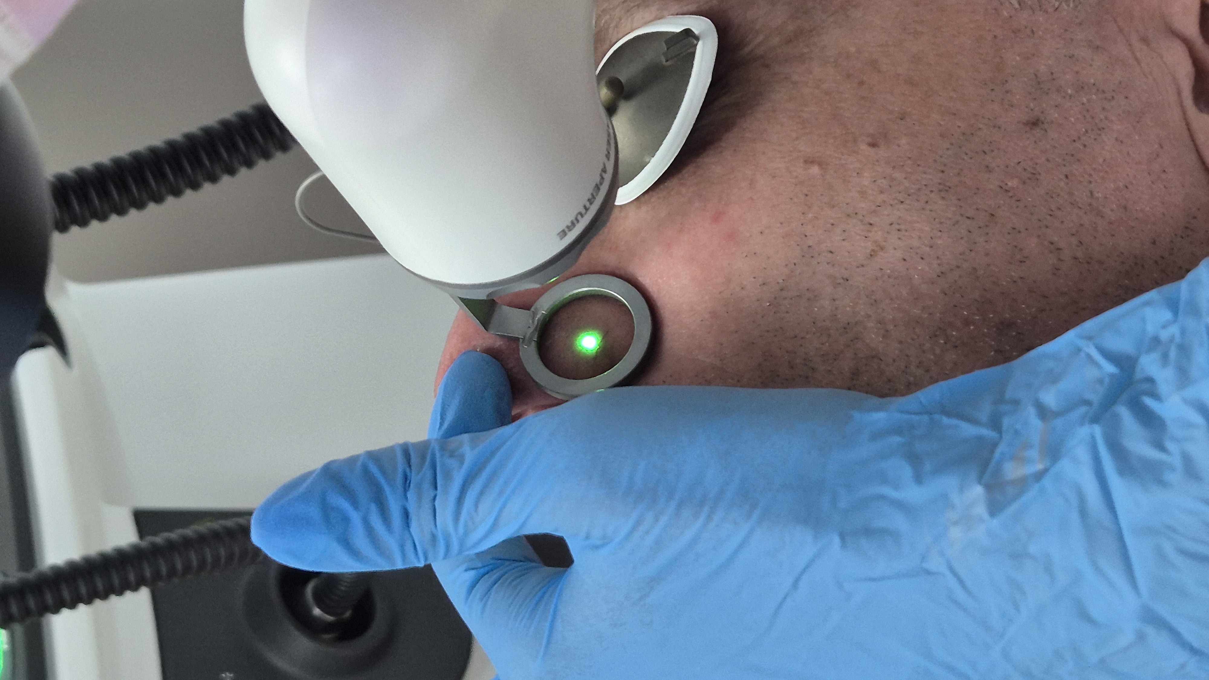 Teleangiektázie odstránenie cievnym laserom ADVAtx v Žiline