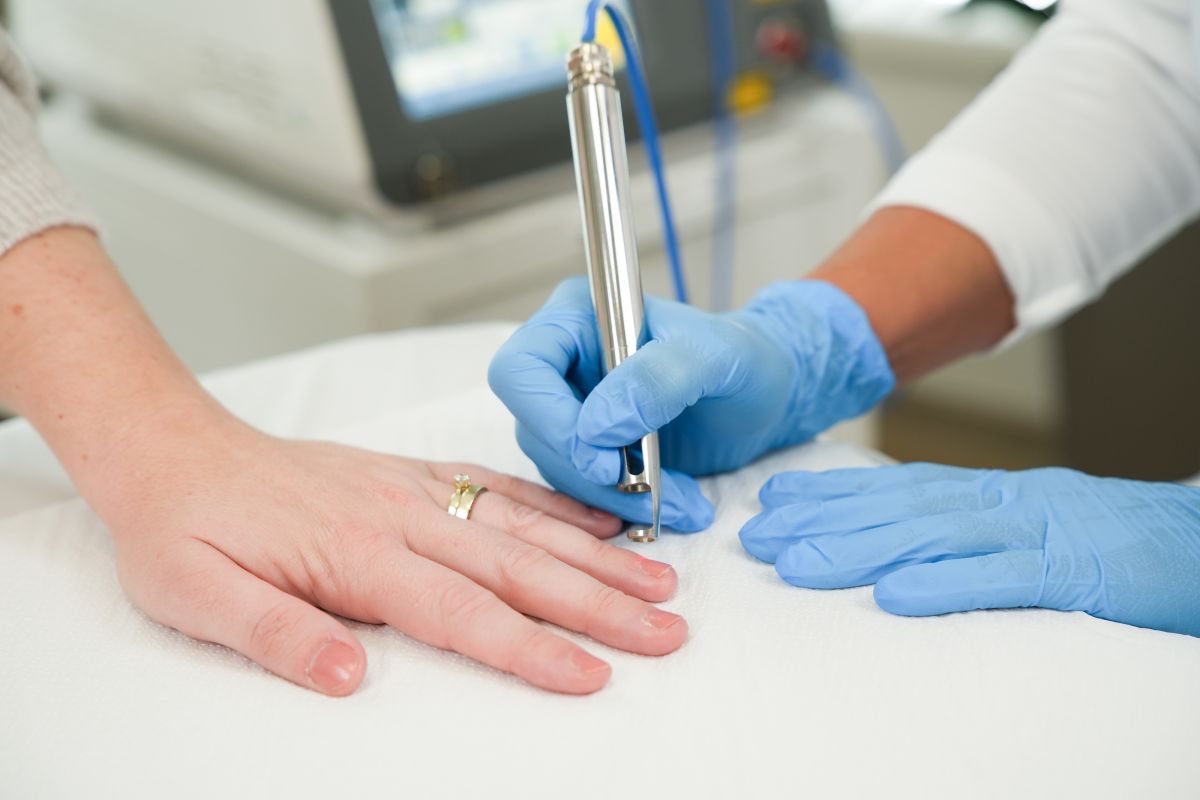 Nechtová mykóza ošetrenie laserom